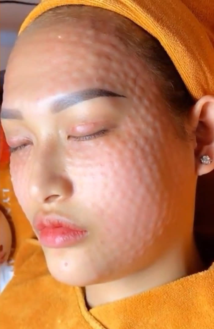 Person with scaly face texture due to controversial beauty trend.