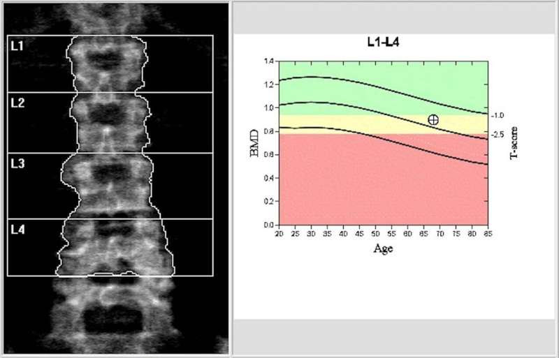 Common thyroid medicine linked to bone loss