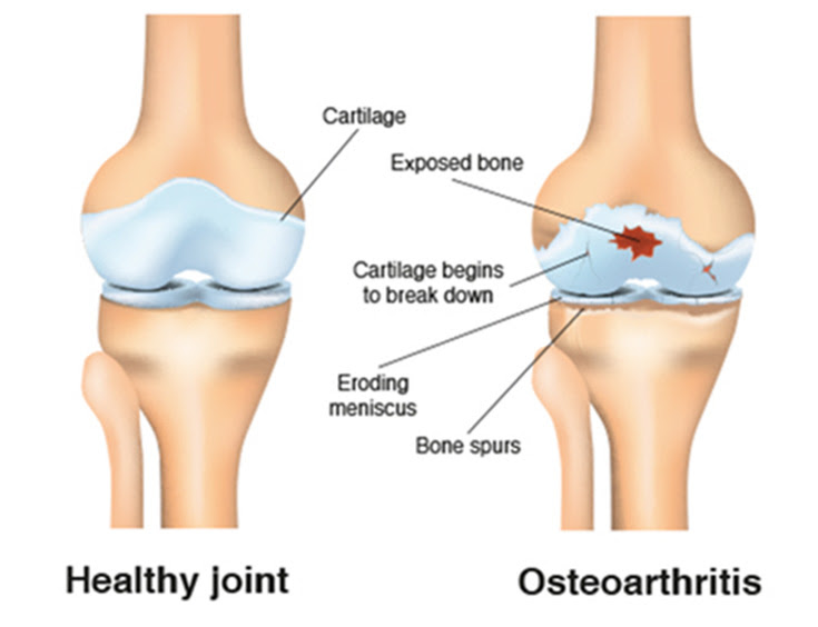 Comparison between a healthy knee joint and one with osteoarthritis