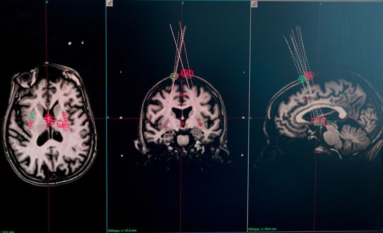 Brain MRI scans of a trial participant.