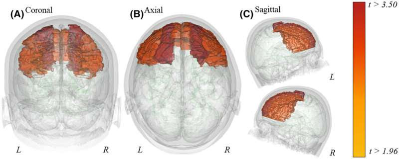 First neuroimaging study of people with avoidant/restrictive food intake disorder