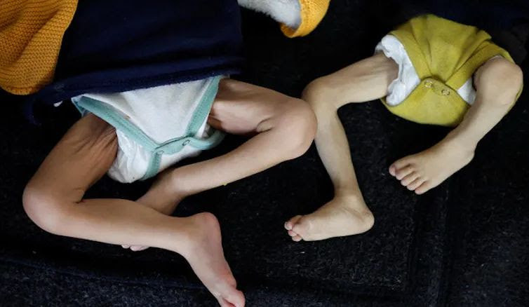 Two infants are shown from the waist down, their legs emaciated.