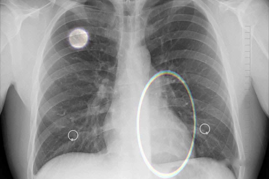 Traiter le cancer du poumon grâce à l'immunothérapie révolutionne la prise en charge des malades