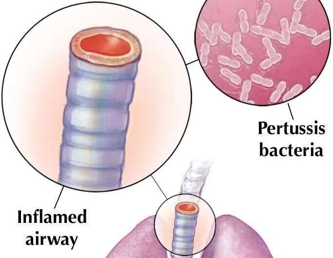 Video: Understanding whooping cough