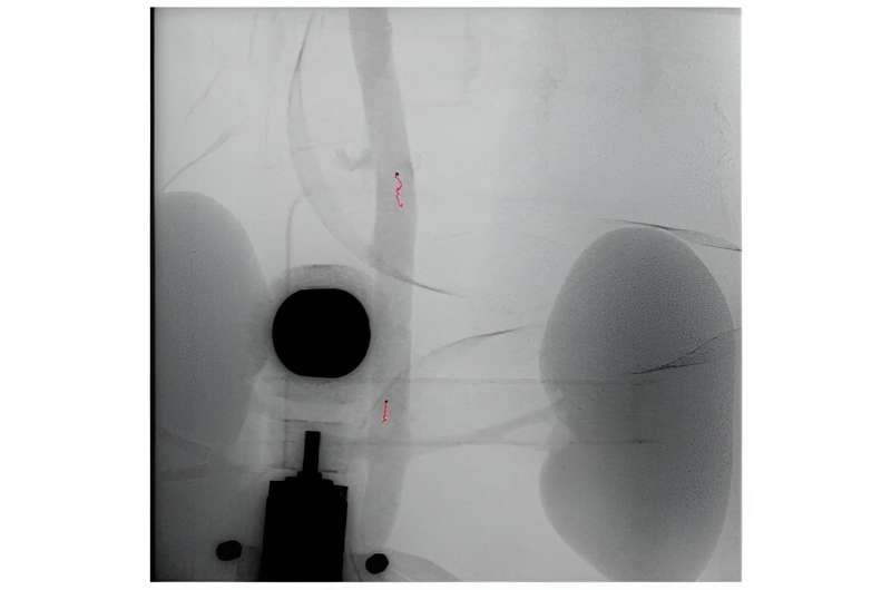 Miniature marvels: Wireless millirobots successfully navigate arteries