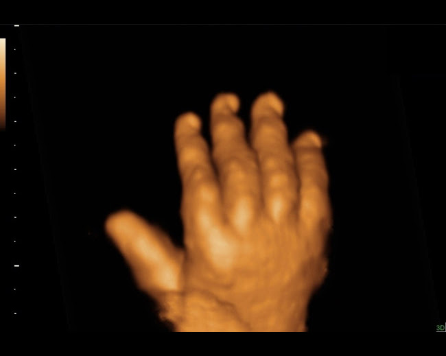 GEHC-Voluson-Second-Trimester_Fetal_hand