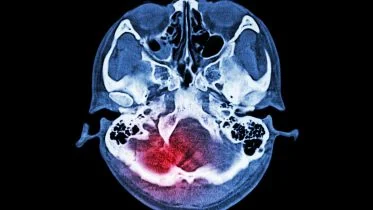 Brain Injury Stroke