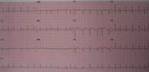 atrial fibrillation