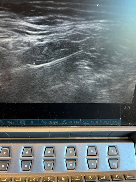 photo of Ultrasound-guided percutaneous cryoneurolysis