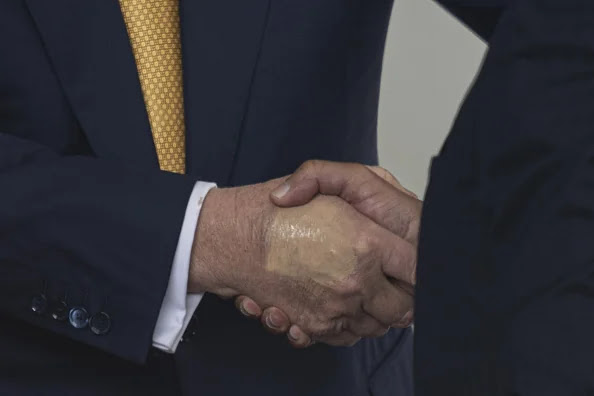 United States President Donald Trump greets the Crown Prince and Prime Minister of the Kingdom of Bahrain Salman bin Hamad bin Isa Al Khalifa at the White House in Washington DC on Monday, July 16, 2025. A bruise is seen on President Trump's right hand (which appears to be covered over with make-up), According to the White House Press Secretary Karoline Leavitt caused by frequent handshakes.