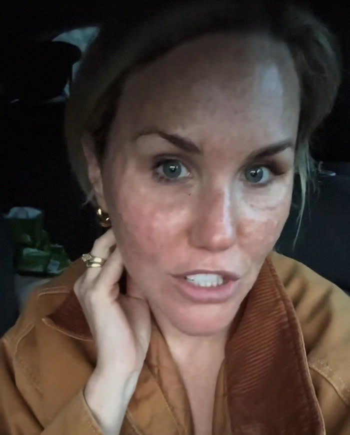 Woman showing skin effects from dangerous beauty trend, visibly resembling reptile-like texture in a car selfie.