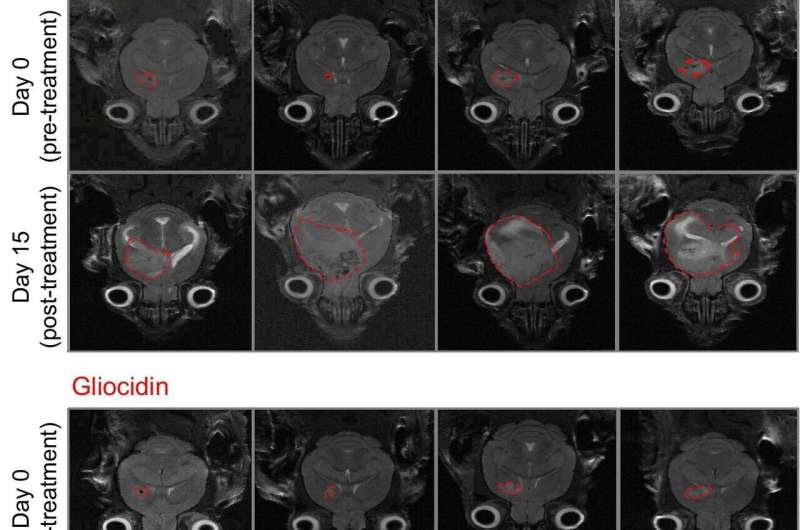 Glioblastoma treatment shows promise in mouse study