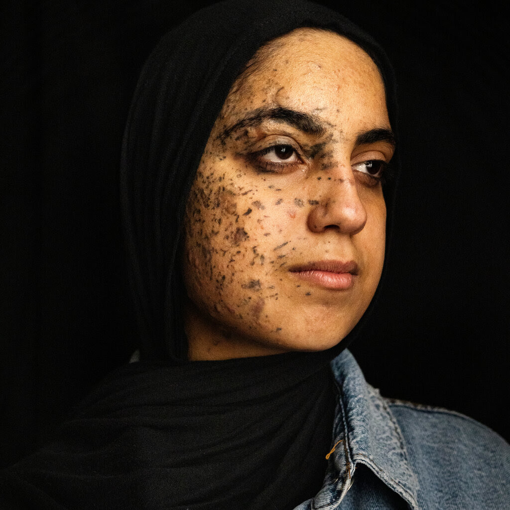 A portrait of a women, her face pitted with dark marks. 