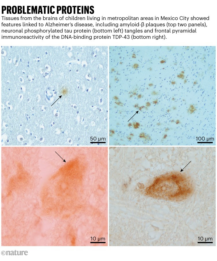 Problematic proteins: Examples of tissues from the brains of children living in metropolitan areas in Mexico City showing features linked to Alzheimer’s disease, including amyloid-β plaques, neuronal phosphorylated tau protein tangles and frontal pyramidal immunoreactivity of the DNA-binding protein TDP-43.