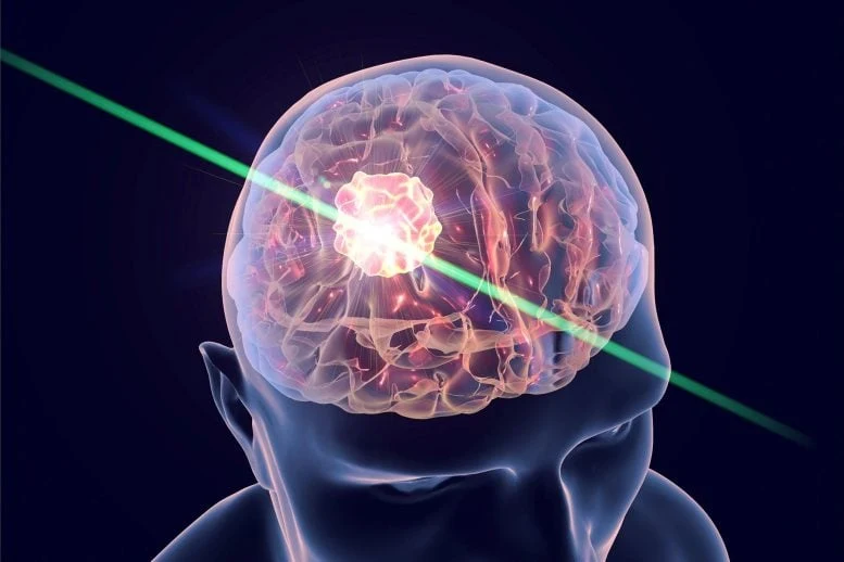 Brain Cancer Laser Treatment