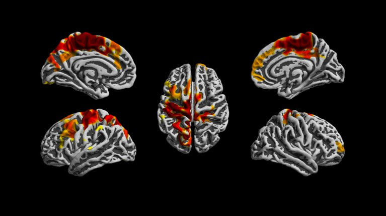 Five brain scans are shown on a black background