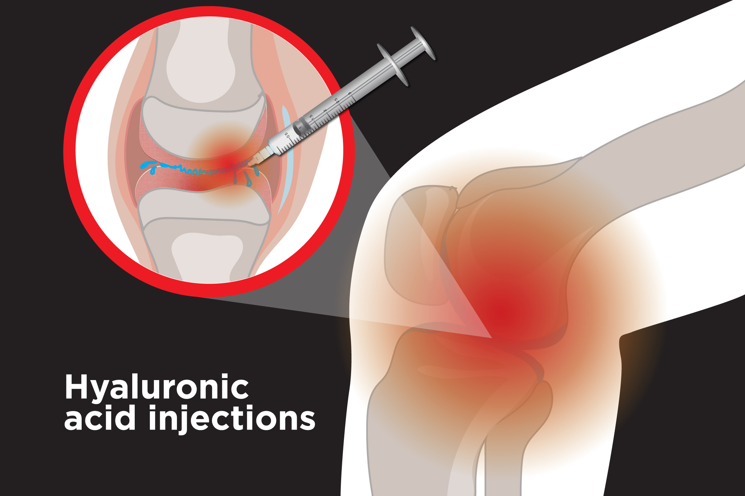 Hyaluronan injections being administered to a knee joint