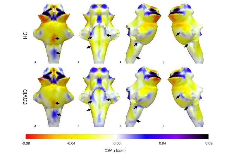 Ultra-powered MRI scans show damage to brain's 'control center' is behind long-lasting Covid-19 symptoms