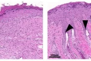 12 days after wounding, untreated skin (left) lacks hair follicles, but TGM treatment (right) promotes the formation of new hair follicles (arrowheads) as the tissue heals and regenerates.