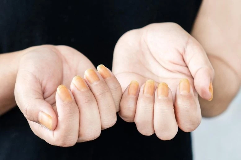 Yellow Fingernails