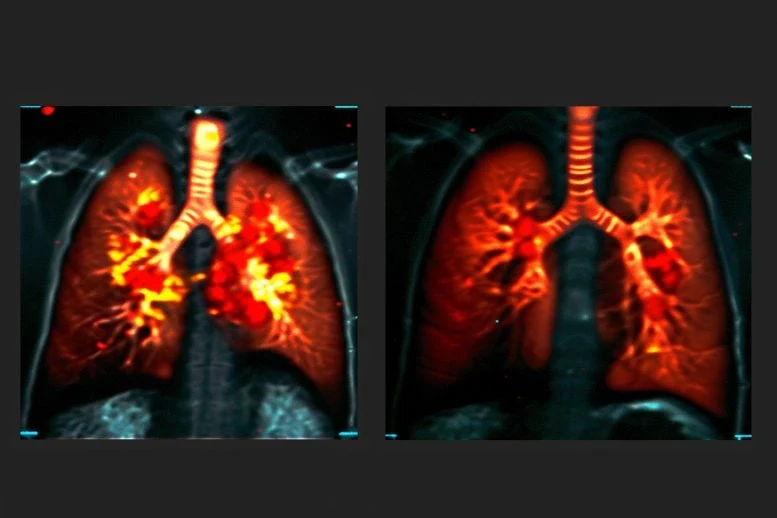 Lung Function MRI Art Concept