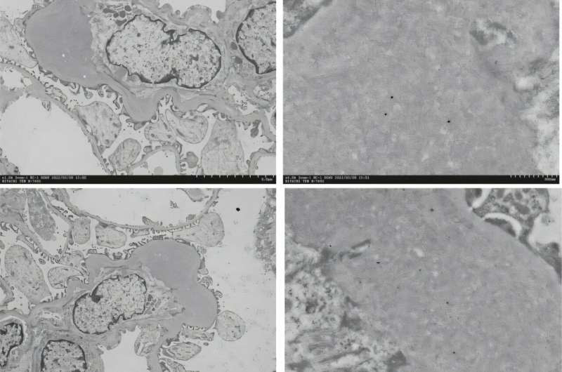 Pathogenic role of dental caries-causing bacteria in IgA nephropathy