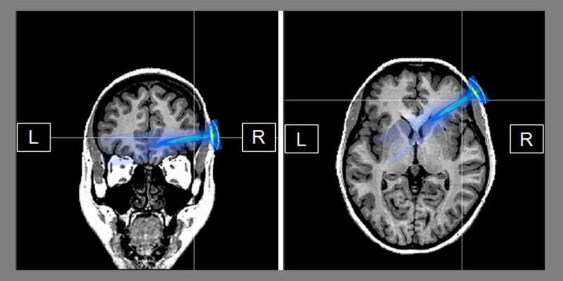 Neuromodulation of the brain with ultrasound waves leads to braver behavior in situations of mental conflict