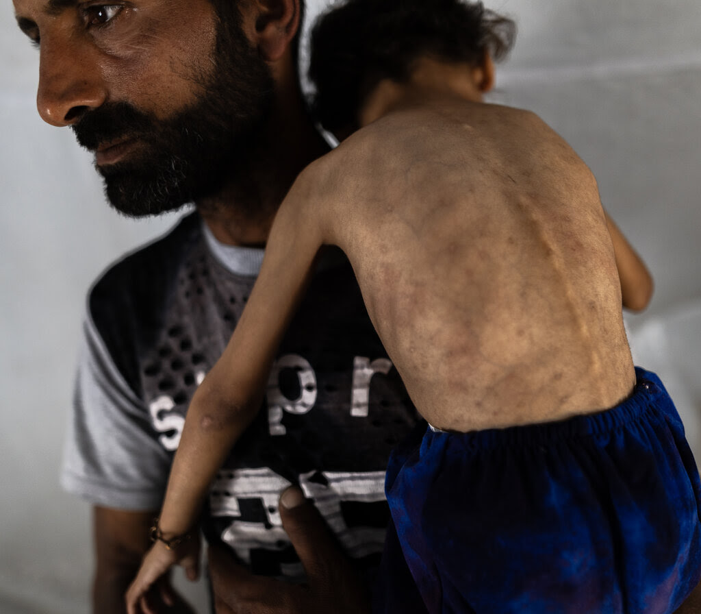 A man holds a malnourished child.