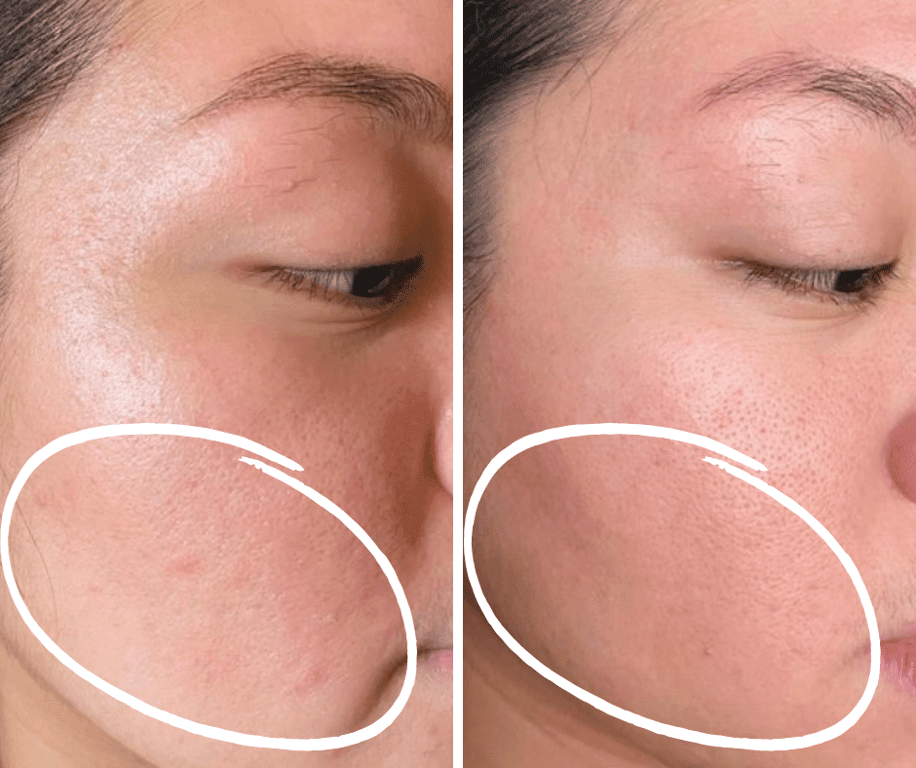 Individual with eczema used 0.2% Retinol + Peptide + Licorice Serum for a month and has reported clearer, brighter skin without burning/irritation with regular retinols.