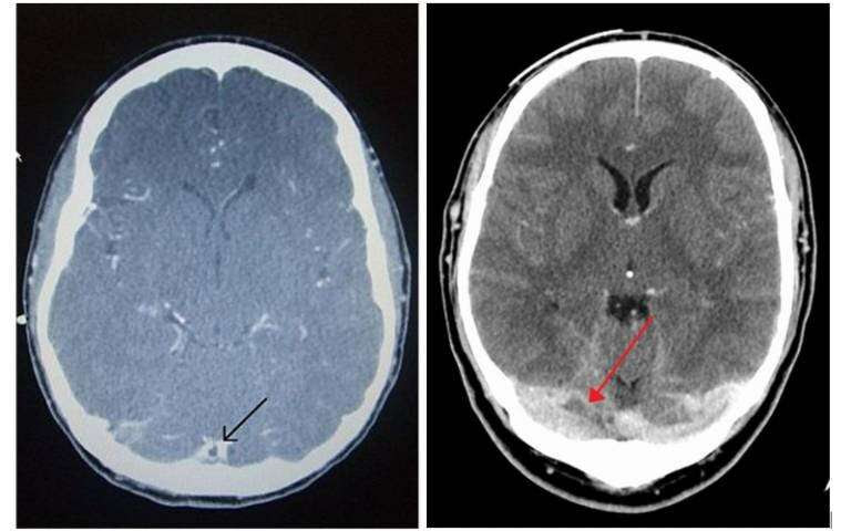 Treatment of rare cases of blood clotting in brain following COVID-19 vaccination