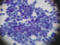 Small cell lung carcinoma