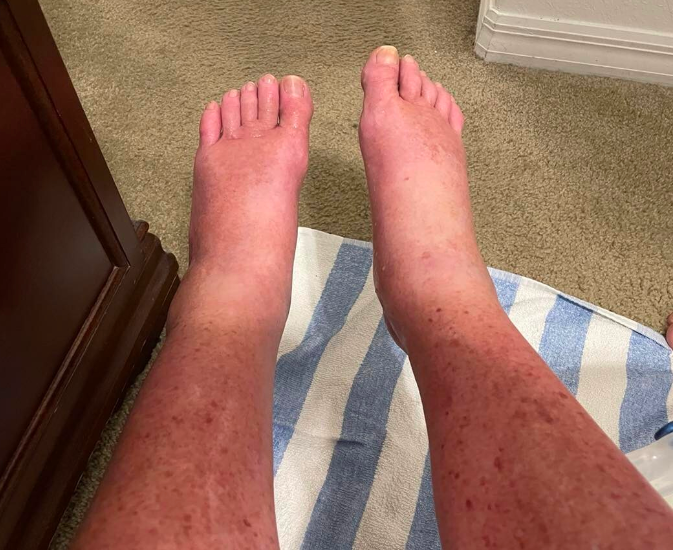 What Swollen Ankles REALLY Say About Your Health (SCARY)