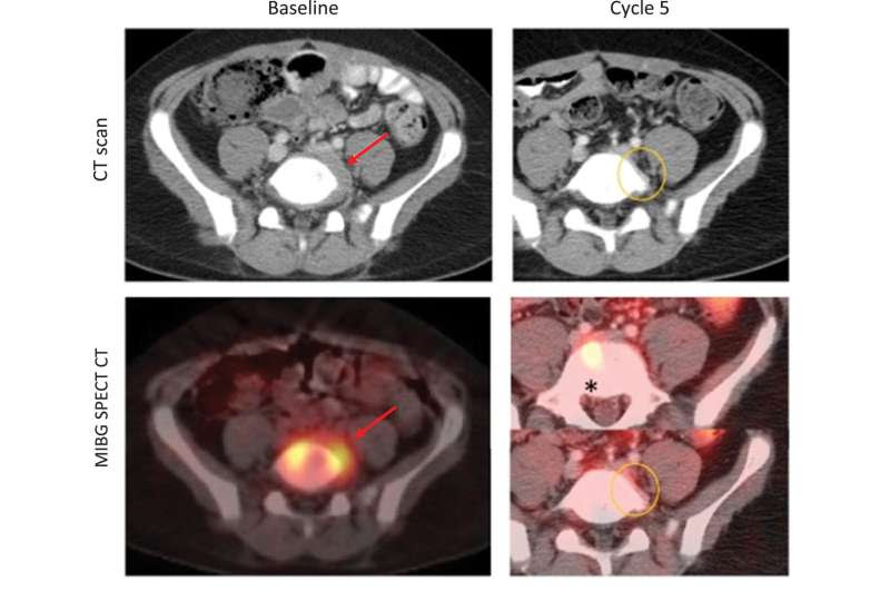 Two studies find role for ALT in treatment-resistant CNS tumors