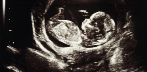 fetus-womb-e1534540332567