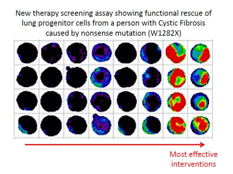 Cystic fibrosis patients may see personalized treatments emerge from “drug screening in a dish,” stem cell research finds