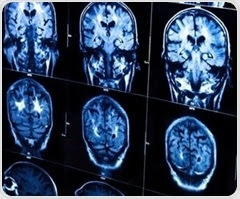 Research findings will help identify genetic causes of brain disorders
