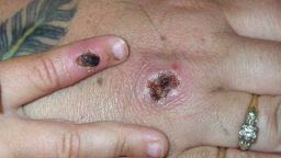 Symptoms of monkeypox include rashes and muscle aches.