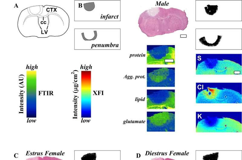 Brain differences in men and women could affect post-stroke outcomes