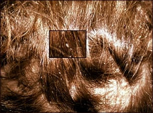 Piojos de la cabeza: primer plano de liendres en el cabello Piojos de la cabeza: primer plano de liendres en el cabello
