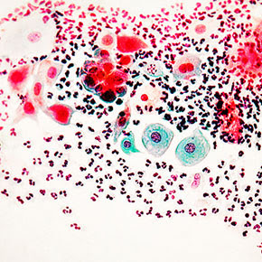 Cervical PAP smear â Science Source/Science Photo Library