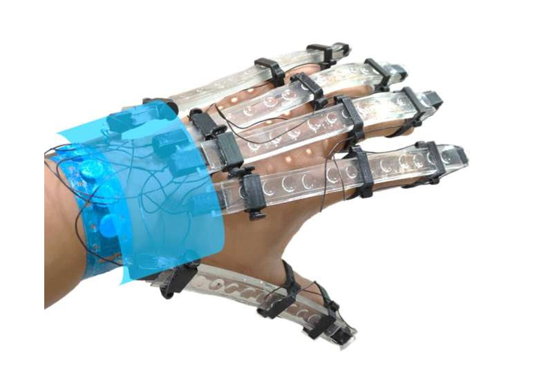 3D printed gloves for rehabilitating stroke patients