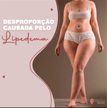 Amanda Djehdian mostra antes e depois um ano após cirurgia de lipedema