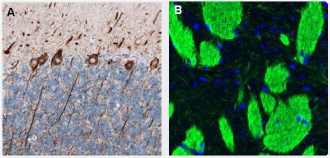 Representative staining of Neurofilament using monoclonal Anti-NEFL antibody (AMAb91314). (A) The human cerebellum shows strong cytoplasmic immunoreactivity in cell bodies and proximal dendrites of Purkinje cells. (B) Immunofluorescence staining of mouse striatum shows strong positivity in neural fibers. See Table 2. for a list of Neuronal Stem Cell markers available from Atlas Antibodies.