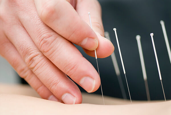 Close-up of hand inserting acupuncture needles