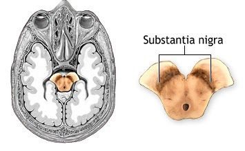 parkinson's disease