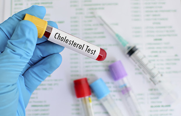 A vial of blood labeled "Cholesterol Test".