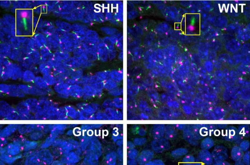 Primary cilia in medulloblastoma: mechanisms provide treatment opportunity