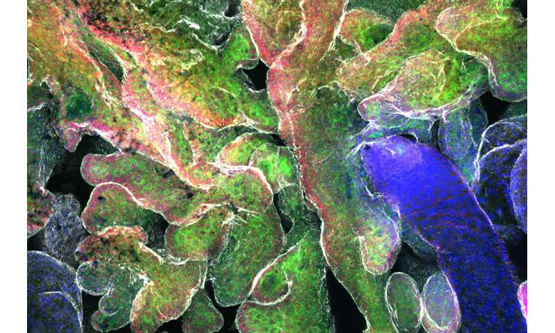 How mechanical forces nudge tumors toward malignancy