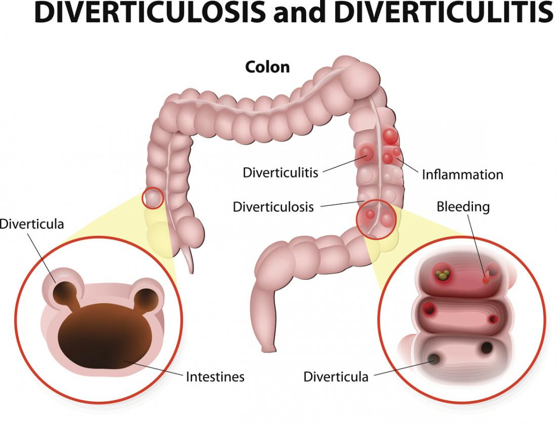 Diverticulitis diverticulosis diagram