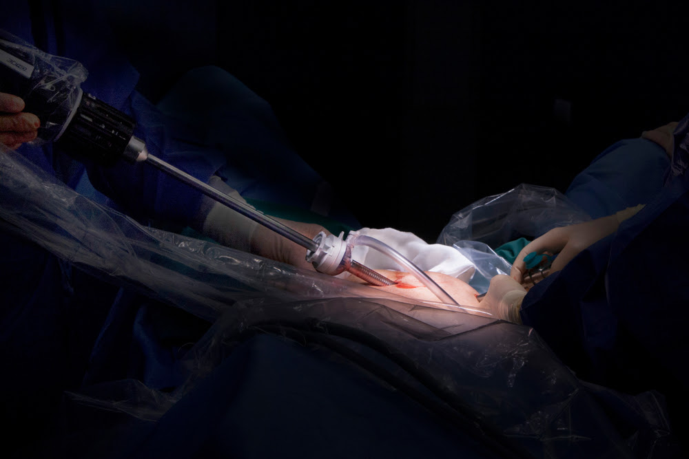 photo d'une prostatectomie totale robot-assistée, Valence, Espagne, 2018